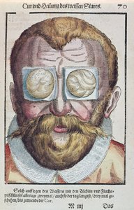 Bir göz rahatsızlığının tedavisi, Georg Bartisch (1535-1636) tarafından Dresden