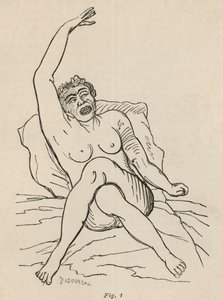 Histerik epilepsi, atak, bükülmeler, şek. 1, Bourneville et P. Regnard, Paris, 1876 tarafından 
