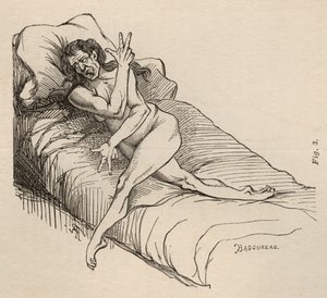 Histerik epilepsi, atak, bükülmeler, şek. 3, Bourneville et P. Regnard, Paris, 1876 tarafından 
