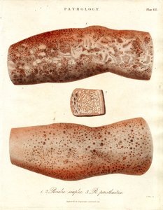 Deri Erüpsiyonları - Roseola simplex ve Roseola paristhmitica