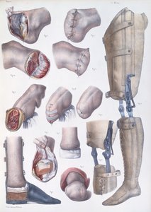 Ampütasyonlar ve Protezler, Jean-Baptiste Marc Bourgery (1797-1849) 1866-67'nin 'Traite Complet de l'Anatomie de l'Homme' adlı eserinden plak by Nicolas Henri Jacob