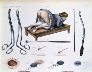 Vezikovajinal fistül üzerinde bir operasyon, Jean-Baptiste Marc Bourgery (1797-1849) 1866-67 (renkli gravür) tarafından 