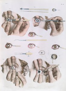 Göz üzerinde operasyon, Jean-Baptiste Marc Bourgery (1797-1849) 1866-67'nin 'Traite Complet de l'Anatomie de l'Homme'dan bir plaka by Nicolas Henri Jacob