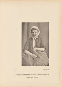 Beyin atrofisi: Parsiyel epilepsi Sol hemipleji by Paul Marie Léon Regnard