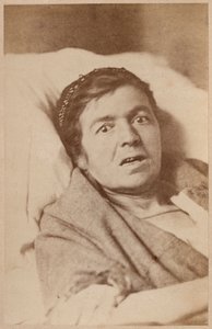 Histerik epilepsi, yüz kasılması, Bourneville ve P. Regnard'ın 'Iconographie Photographique de La Salpetriere' adlı eserinden VIII. plaka, Paris, 1876 (albüm baskısı) by Paul Regnard