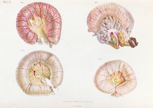 Kolera ile enfekte olmuş bağırsakların dış yüzeyi, Anatomie Pathologique du Cholera Morbus
