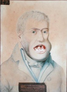Guillaume Dupuytren (1777-1835) tarafından başarıyla ameliyat edilen alt çene osteosarkomu (kağıt üzerine kalem) by School French