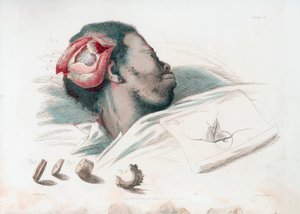 Trepanasyon sonrası kafatasındaki yaranın görünümü ve sol altta parçalanmış kemik parçasının çıkarılması, 1821 by Thomas Landseer