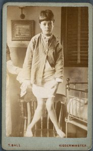 Hastalıklar, Raşitizm (Rachitisme, jambes rahitiques) Raşitizmli çocuk by Unbekannt