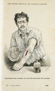 Bir yarayı antiseptik solüsyonla boyamak, c1890 by Unbekannt