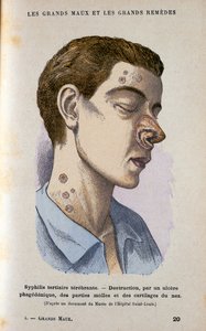 Sifilizin üçüncü evresinin belirtileri, c19. yüzyıl by Unbekannt