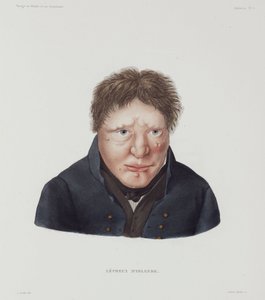 Hastalıklar, Cüzamlı Erkek cüzamlı, İzlanda, 19. yüzyılın başları by Unbekannt