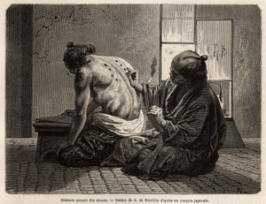 Moxas (vücudun belirli bölgelerinde yakılan küçük adaçayı kozalakları), hazımsızlıktan iştahsızlığa, ağlama ve diş ağrısına kadar çeşitli semptomlara karşı koruyucu bir tedavi olan bir doktor, yılda iki kez çalışır ve Japonlar tarafından sabit bir süreye s by Unknown artist