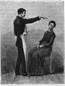 Hipnotizma fenomeni: Elin aniden hastanın önünde uzatılmasıyla hipnotizma üretilir. 1881