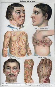 Deri hastalıkları: Egzama, dudak uçuğu, sedef hastalığı, zona, lapus (çürüyen darter), prurigo, eritem. Yeni doğal ilaç”” F.E. Bilz. by Unknown artist