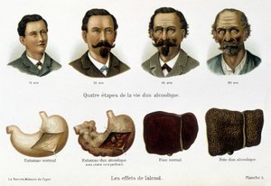 Alkolün etkileri: alkoliklerin yüzleri ve karaciğerleriyle temsil edilen yaşamının dört aşaması. - “kadın, ev doktoru”nda” by Unknown artist