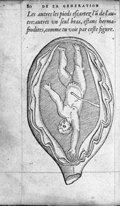 Hamilelik sırasında fetüsün rahimdeki konumu. Fransız doktor ve cerrah Ambroise Pare (1509-1590) tarafından “De la Generation des enfants”dan gravür 16. yüzyıl by Unknown artist