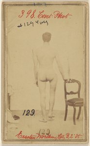 Femurun üst üçte birlik kısmında kırık. Erastus Worthen, Corp Co. B. 2nd Vermont Vols. 25 yaşında - İkamet Stockbridge VT. by Unknown artist