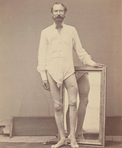 Sol Femurun Orta Üçte Bir Ateşli Silah Yarası, 1865-67.