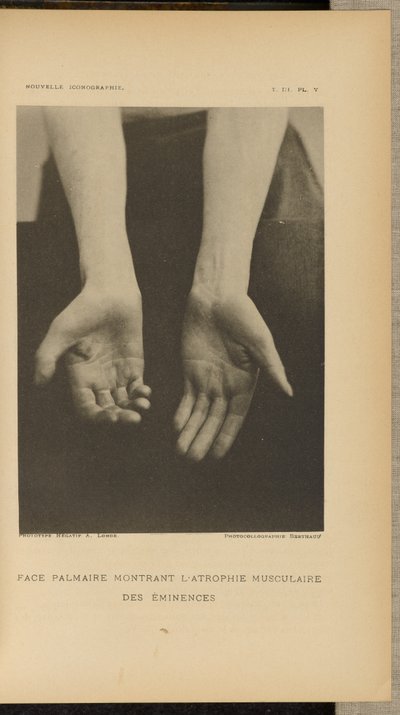  by Albert Londe