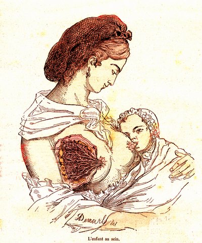 Memedeki çocuk (J. Rengade'nin normal yaşamı ve sağlığı) - Emzirme. A. Demarle'ın çizimi 1881 by Alphonse Demarle