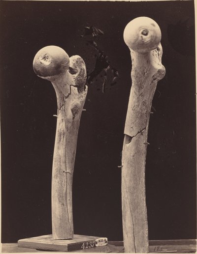 Femur Ateşli Silah Kırıkları Örnekleri by American 19th Century