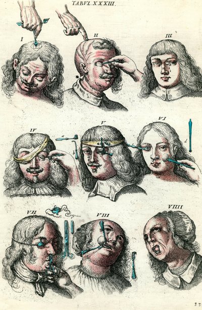 18. yüzyılda cerrahi: Göz ve yüzün trepanasyonu ve operasyonu. Lorenz Heister