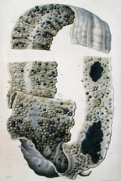 Jean Cruveilhier (1791-1874) 1828-42 (renkli gravür) tarafından 