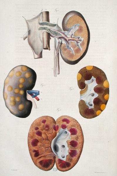 Jean Cruveilhier (1791-1874) 1828-42 (renkli gravür) tarafından 