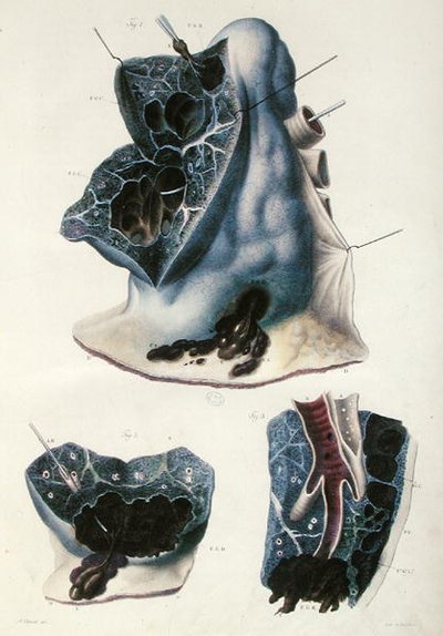 Akciğer hastalıkları, Jean Cruveilhier (1791-1874) 1828-42 (renkli gravür) tarafından 