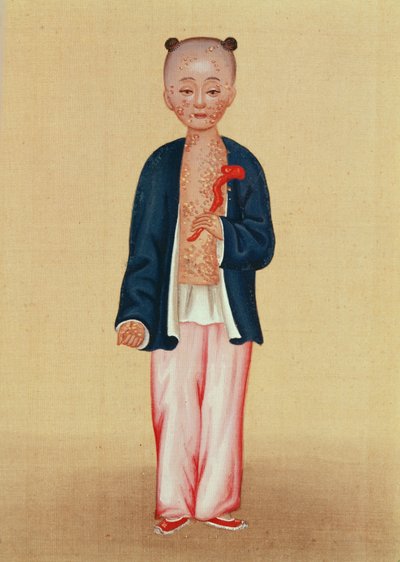 Çiçek hastalığı olan çocuk (kağıt üzerinde wc) by Chinese School
