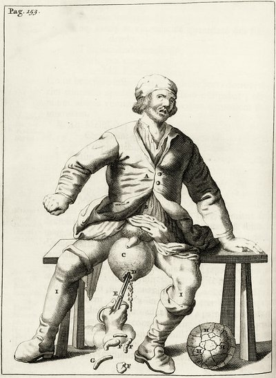 Skrotumun hidroselinden sıvının boşaltılması, by Dutch School