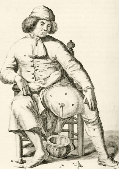 Bir apseden sıvıyı boşaltmak, Frederik Dekkers, 1694 by Dutch School