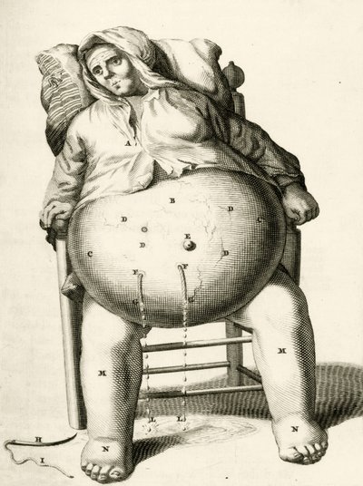 Bir apseden sıvıları boşaltmak, Frederik Dekkers, 1694 by Dutch School