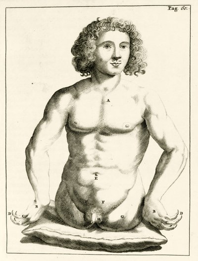 Frederik Dekkers tarafından konjenital doğum kusurları örneği, 1694 by Dutch School