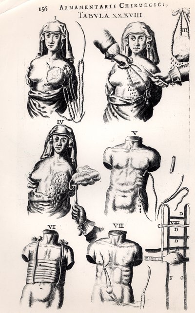 Meme kanseri üzerinde ameliyat, Johannes Schultes (1595-1645) tarafından Amsterdam