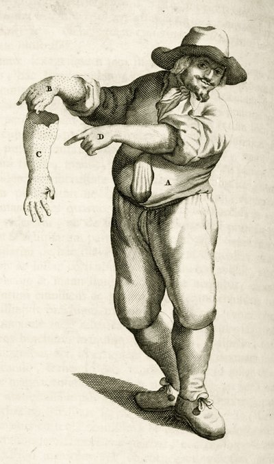Frederik Dekkers tarafından Tıbbi Yöntemlerde Pratik Egzersizlerden püstüllerle ölü derinin çıkarılması, 1694 by Dutch School
