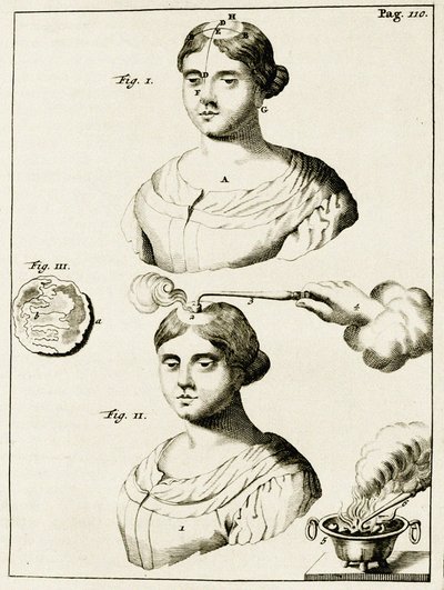 Epilepsi hastasını tedavi etmek, Frederik Dekkers, 1694 tarafından Tıp Uygulamasında Alıştırmalardan by Dutch School