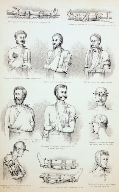 Kırıkların Geçici Tedavisi, c.1890 by English School