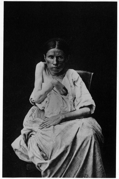 Hemiplejik epilepsiden muzdarip bir hastanın fotoğrafı, - Salpetrière, Bourneville ve P. Regnard, Paris