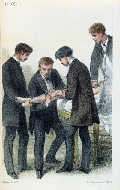 Bir kolun kesilmesi, Jean-Baptiste-Leon Dubreuil