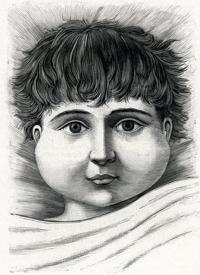 Kabakulak hastalığı olan çocuk (gravür) 1888 by French School
