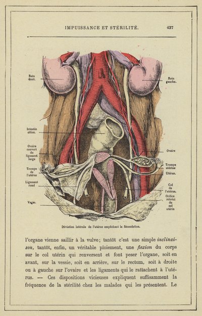 Döllenmeyi engelleyen uterusun lateral deviasyonu (renkli taş) by French School