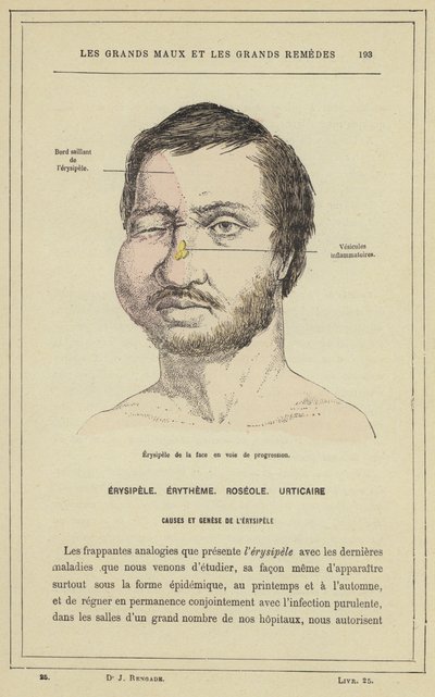 İlerleyen yüzün erizipeli (renkli lito) by French School
