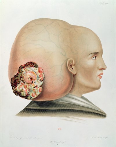 Dura mater mantarı, Selecta Praxis Medico-Chirurgica