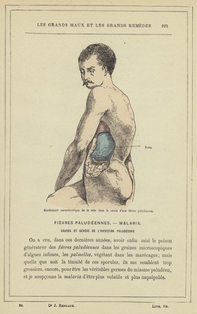 Sıtma ateşi sırasında dalağın karakteristik şişmesi (renkli taş) by French School