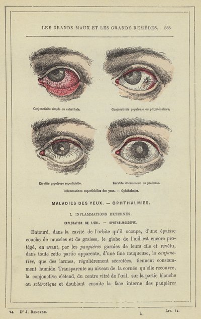 Yüzeysel göz iltihabı, Oftalmi (renkli taş) by French School