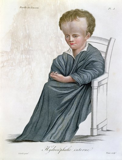İç Hidrosefali, Baron Jean Louis Alibert (1768-1837) tarafından Nosologie Naturelle