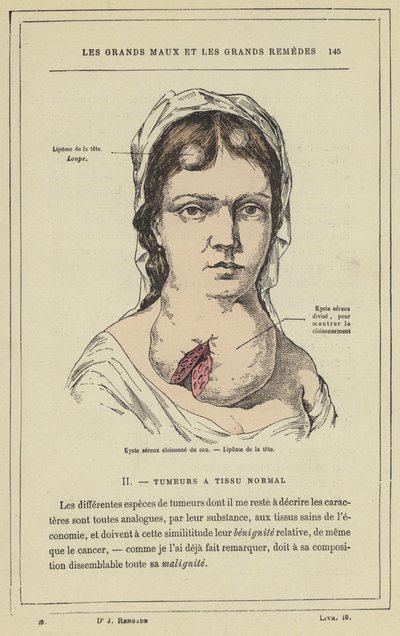 Boynun emaye işi seröz kisti, Başın lipomu (renkli lito) by French School