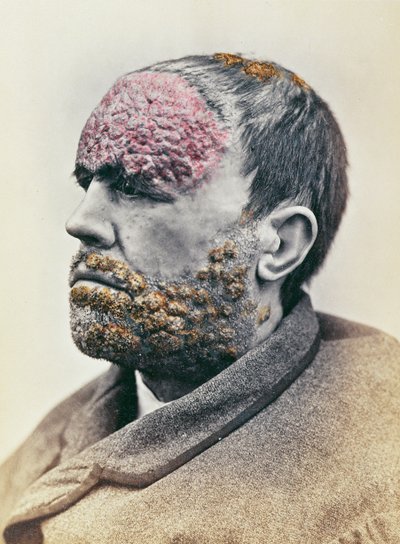 Frengi olan adam, Clinique Photographique de lHopital Saint-Louis için çekilmiş bir fotoğraftan, 1868 by French School